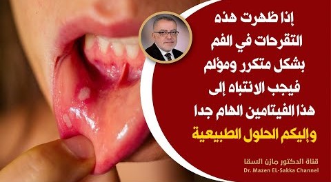 ما هي أفضل وصفة لعلاج تقرحات الفم ؟ وماذا يعني ظهورها المتكرر انتبهوا لهذا السر المهم في العلاج
