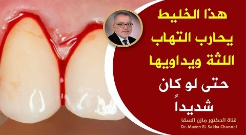 أفضل دواء لعلاج التهاب اللثة من الجذور وداعاً لـ تورم ونزيف اللثة | سبب التهاب اللثة الخفي وانتفاخها