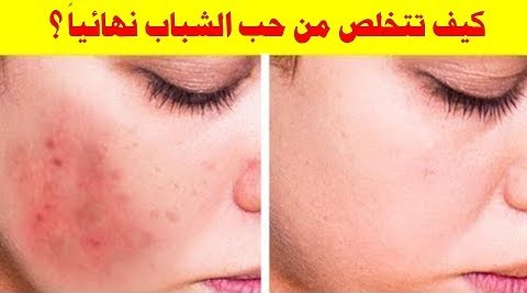 كيف تتخلص من حب الشباب نهائياً ؟ علاج حب الشباب واثاره بسرعه بطرق طبيعية وسهلة