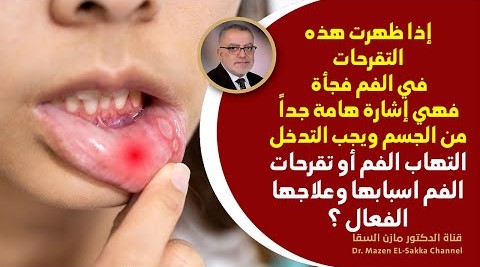 إذا ظهرت تقرحات الفم واللثة فهي علامة ضرورية لهذا الخلل في الجسم ! علاج تقرحات الفم واللثة طبيعيا ؟
