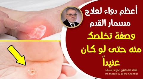 أعظم دواء علاج مسمار القدم الفعال بدون ادوية، ما لا تعرفه عن مسمار القدم أسبابه وعلاجه وطرق الوقاية