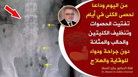 مشروب معجزة يفتت حصوات الكلى | من اليوم يمكن علاج حصوات الكلى في أيام ودعم الكلى والحالب والمثانة