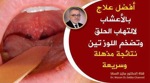 قطعة من القرنفل تجعلك 100 حصان وداعا لألم التهاب الحلق علاج وتقصيرمدة التهاب الحلق والتهاب اللوزتين