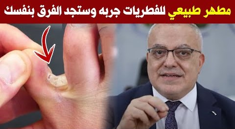 اسرع وأرخص وأبسط علاج لفطريات القدمين مطهر طبيعي للفطريات أيا كان مكان الاصابة بها علاج فعال مبهر
