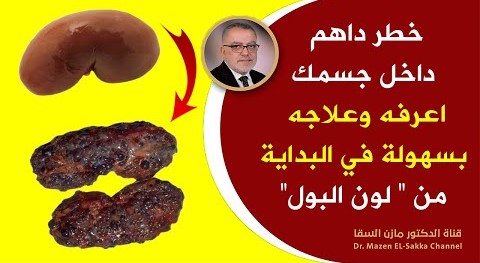 انتبه ! ماذا يخبرك لون البول عن جسمك ؟ علامات مهمة يجب أن تنتبه لها الآن وتقرر بعدها حالتك الصحية